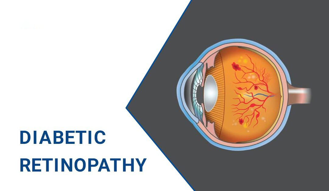 糖尿病视网膜病变–原因、阶段和治疗