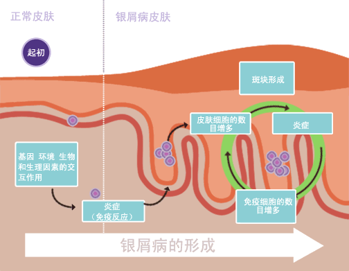 银屑病治愈：是科学事实还是虚假希望？