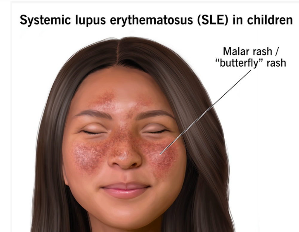 什么是儿童系统性红斑狼疮？及其病因和治疗方法