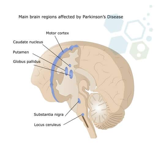 帕金森病影响区域