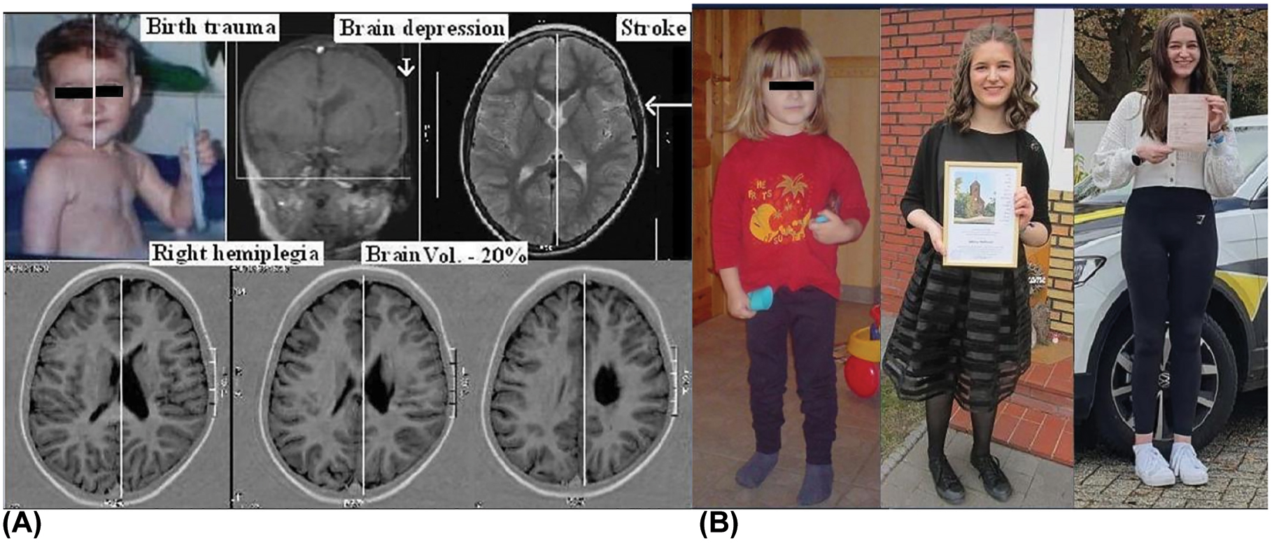 图 2：创伤是先天性脑瘫的风险因素。（A）创伤性胎儿脑损伤。一名 5 岁女孩在分娩过程中头部创伤性塑形导致新生儿动脉缺血性中风后，进行了自体人脐带血 MNC 移植的个体试验。患者单侧白质损失约 20%，导致偏瘫。（B）从移植五年后开始，女孩的偏瘫程度有所恢复，现在她能够参加城市耐力跑，获得游泳和跳水救生员证书（DLRG金牌），骑两轮自行车，获得驾驶执照，并用她受伤的右手弹钢琴。
