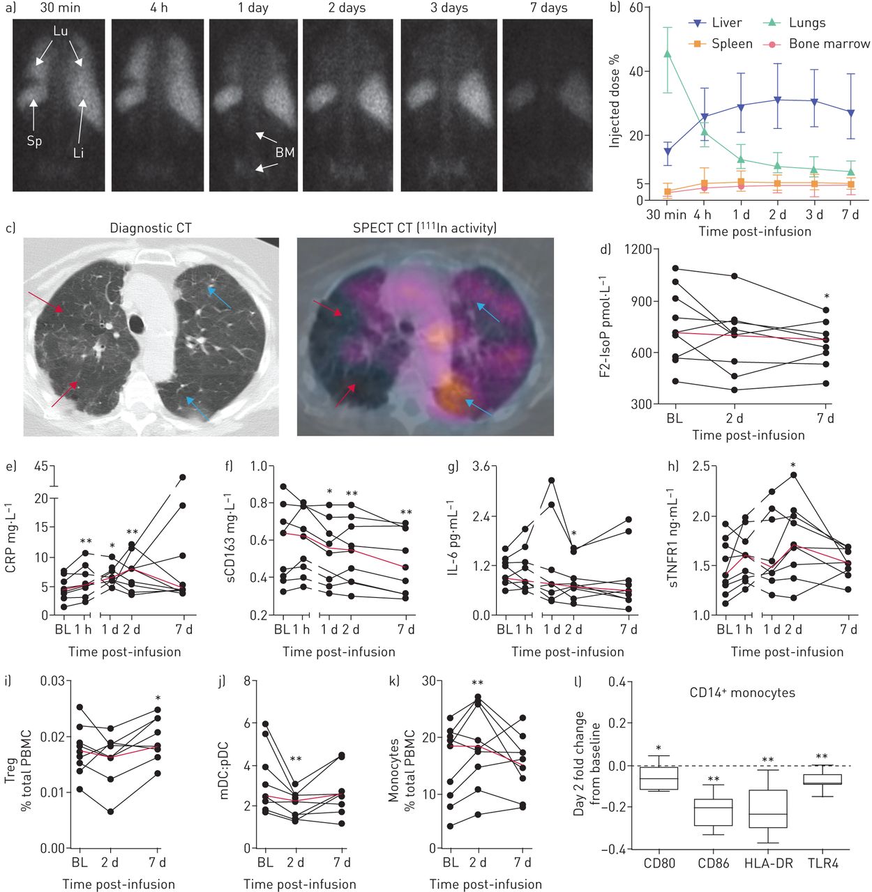 输注后 7 天内，铟-111 存在于肺 (Lu) 中，其次是肝脏 (Li)、脾脏 (Sp) 和骨髓 (BM) (a)

通过感兴趣区域 (ROI) 分析 (平均值和标准偏差) 定量测量，并根据背景和衰减进行校正 (b)

可见肺气肿变化的区域显示放射性标记的存在最少 (红色箭头)，而受影响不太明显的区域显示放射性标记积累水平较高 (蓝色箭头) (c)

输注 7 天后，氧化应激标志物 F2-异前列腺素 (F2-IsoP) 水平下降 (d)

促炎标志物如 C 反应蛋白 (CRP) 在输注后 1 小时至 2 天内显著升高 (e)

而可溶性 (s)CD163 水平从 1 天起下降 (f)

白细胞介素 (IL)-6 在输注后 2 天下降 (g)

输注后 2 天循环 sTNFR1 也增加 (h)

输注后 7 天循环免疫细胞（包括调节性 T 细胞 (Tregs)）的比例增加 (i)

而髓样 (mDC) 与浆细胞样 (pDC) 树突状细胞的比例降低 (j)

输注后 2 天 CD14 +单核细胞水平增加 (k)

并且这些单核细胞在第 2 天与基线相比 CD80、CD86、人类白细胞抗原-DR (HLA-DR) 和 TLR4 显著降低， (l) 

每张放射图像均显示一名患者的代表性图像。黑线代表每个患者的时间过程，红线代表中位数，以显示总体趋势。使用 Wilcoxon 符号排序检验进行统计分析，以比较基线和输注后水平。CT：计算机断层扫描；SPECT：单光子发射计算机断层扫描；PBMC：外周血单核细胞。