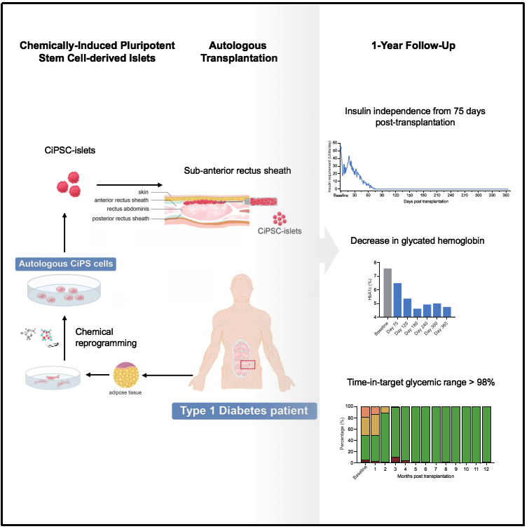图1：基于CiPS细胞治疗1型糖尿病的临床研究的示意图和治疗效果