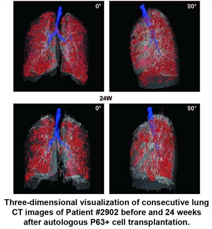 患者#2902在自体P63+细胞移植前后24周连续肺部CT图像的三维可视化。