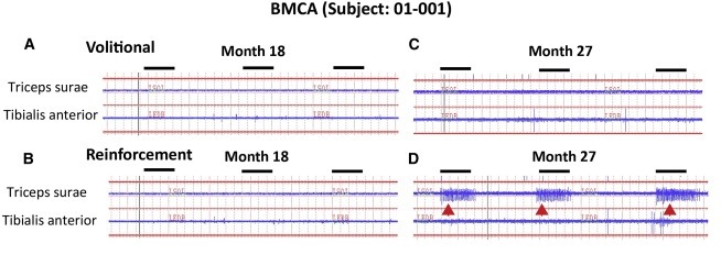 图2：患者1脑运动控制评估(BMCA)和EMG评估