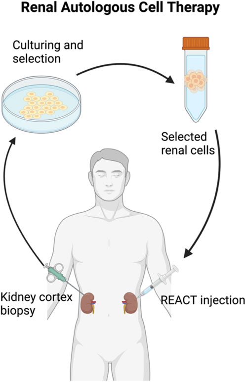 图2：自体细胞治疗肾脏疾病