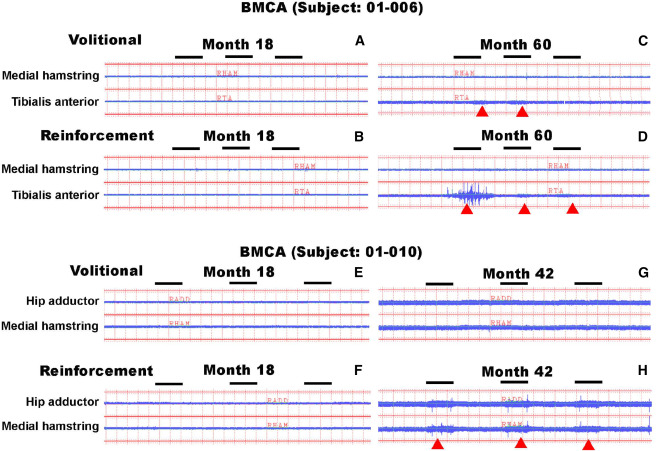 图5：BMCA识别自愿或强化动作引发的EMG活动